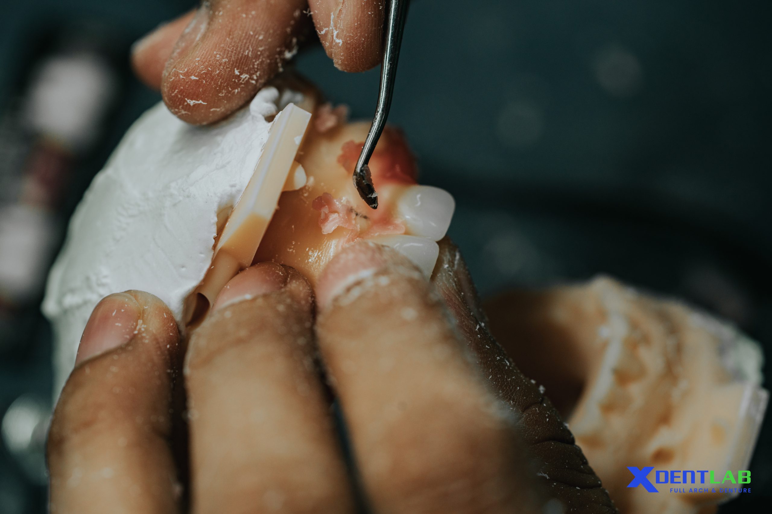 Workflow for Implant-Supported Dentures Outsourcing